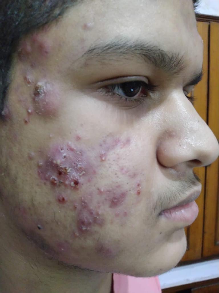 Before acne treatment at Clinica Medicare