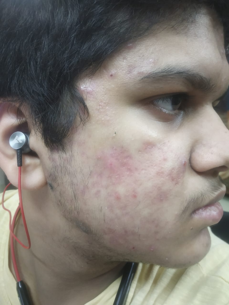 Acne treatment result at Clinica Medicare