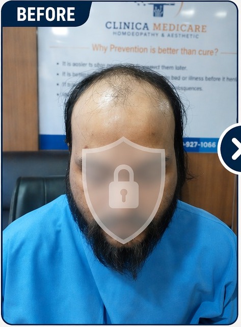Before hair fall treatment at Clinica Medicare