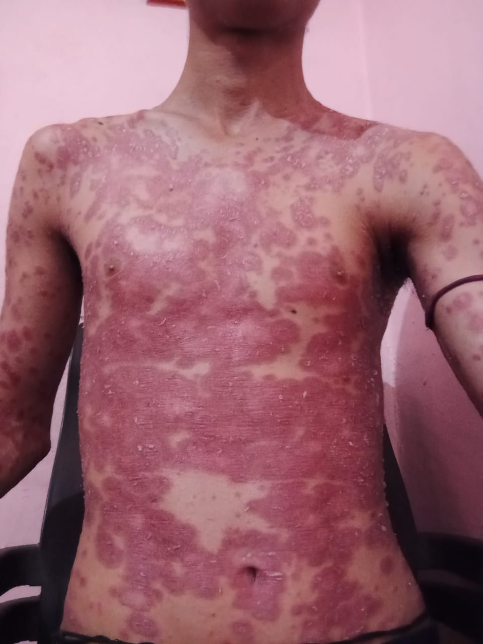Before skin treatment at Clinica Medicare