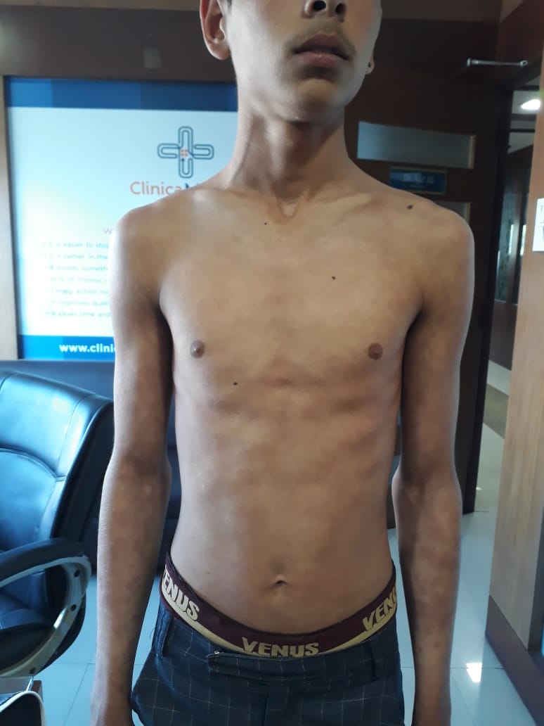 Skin treatment result at Clinica Medicare Bhopal