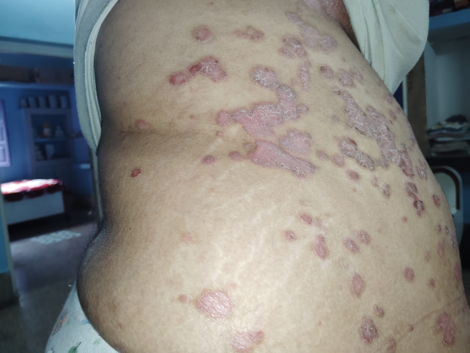 Before skin rejuvenation treatment